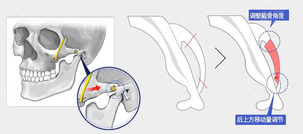 zygoma reduction