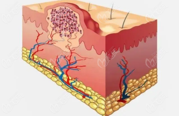 Injection scar removal technique