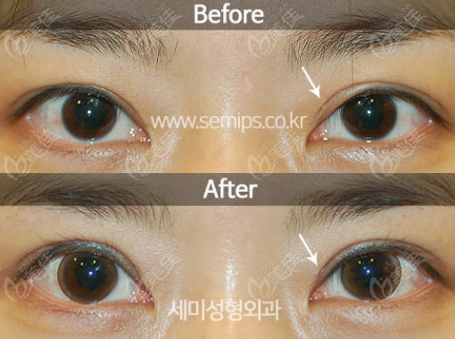Repairing Flesh-like Strips