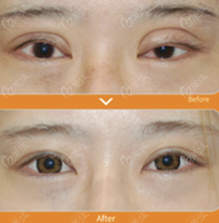 Repairing Wide Double Eyelids
