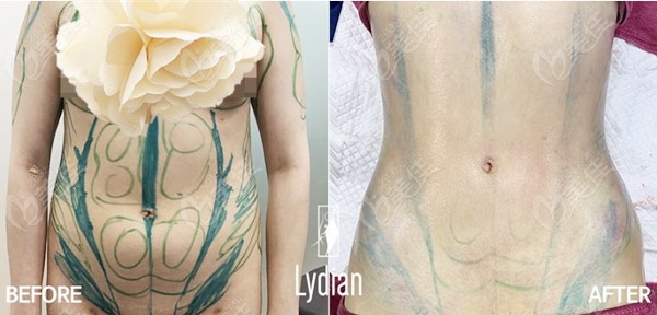 How is V-line Abdominal Liposuction Performed?