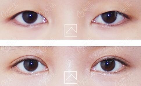 Misoline Plastic Surgery's double eyelid surgery
