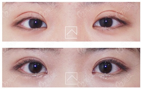 double eyelid repair surgeries