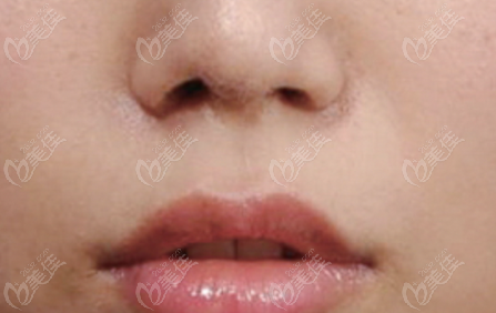  after the Nasal Reconstruction