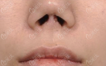 Before the Nasal Reconstruction