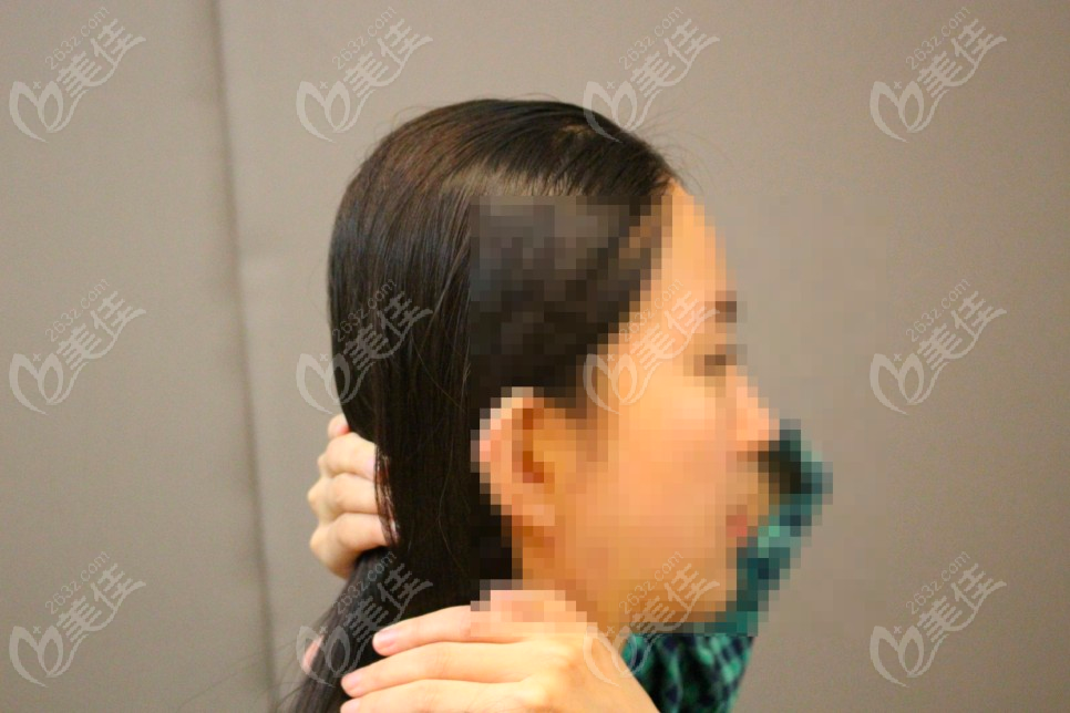Posterior Skull Augmentation