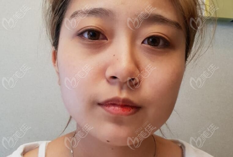 Comparison of before and after contour surgery: