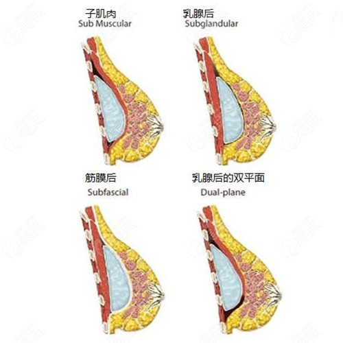 breast augmentation surgeries