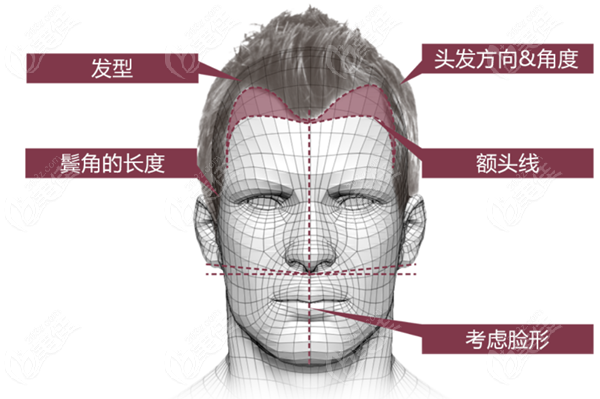 hair transplant