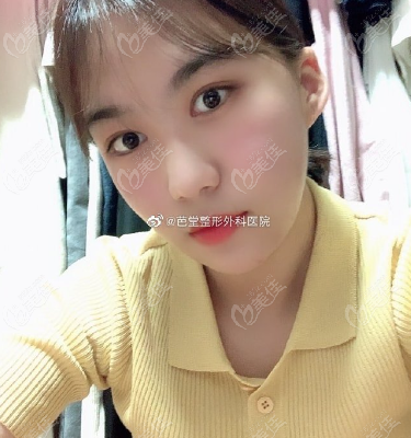 underwent double eyelid surgery