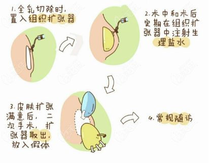Breast Reconstruction