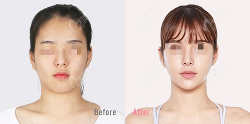 rhinoplasty at Cinderella