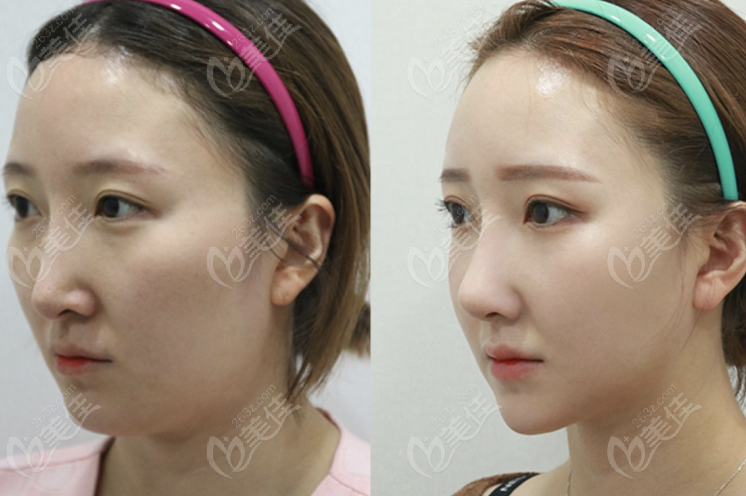Natural facial line