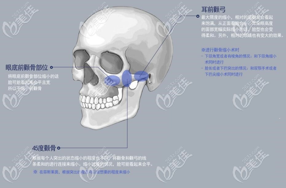 cheekbone reduction