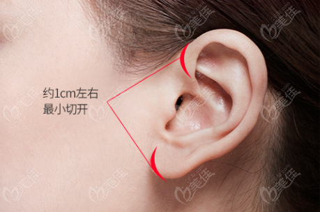 only two 1cm incisions in front of the ear