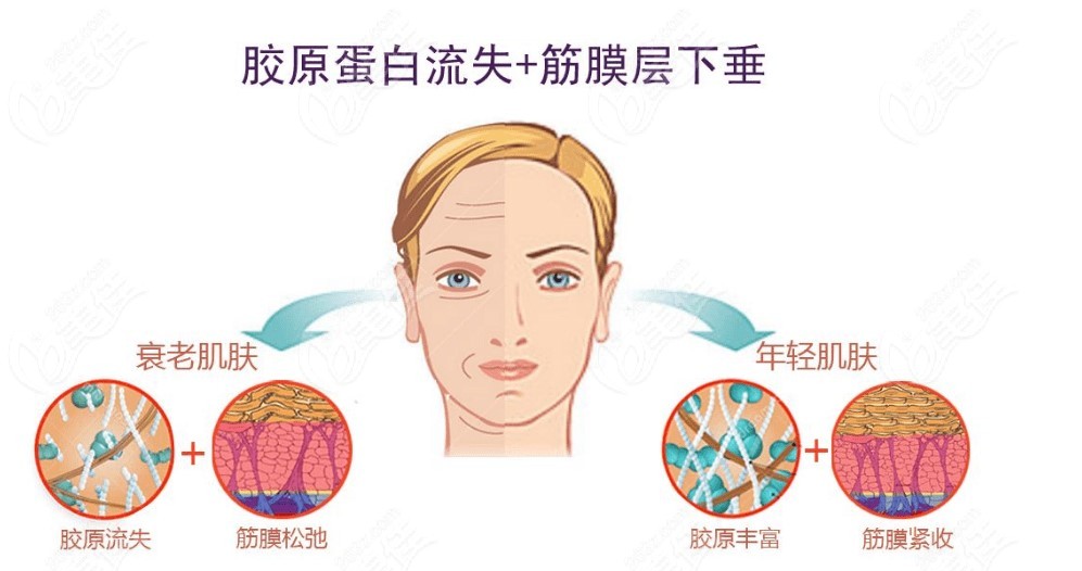 Facial Lifting