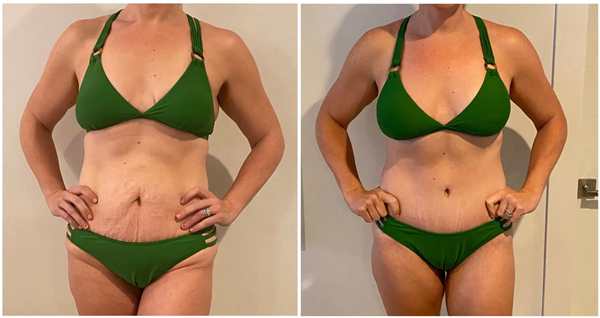 How much belly fat can lipo remove?