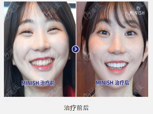 dental veneer treatments