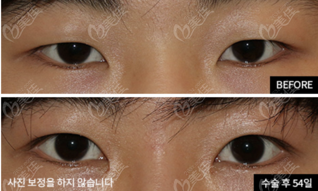 Male Eye Correction