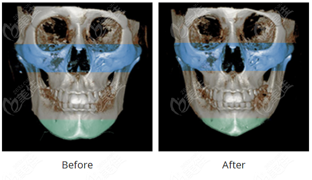zygoma reduction 