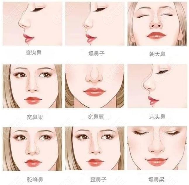  Rhinoplasty