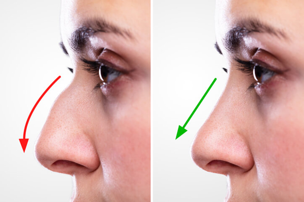 3 Best Clinics for a Nose Job in Korea