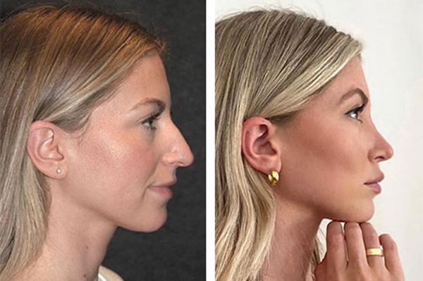 Rhinoplasty