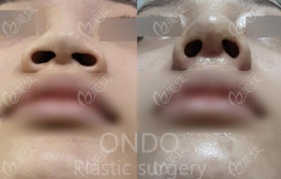 Nose Job