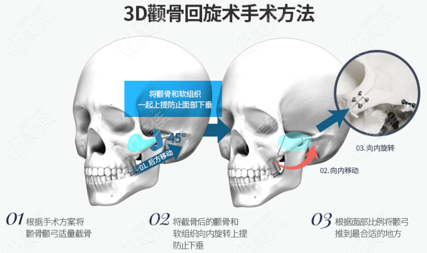 3D zygoma rotation surgery