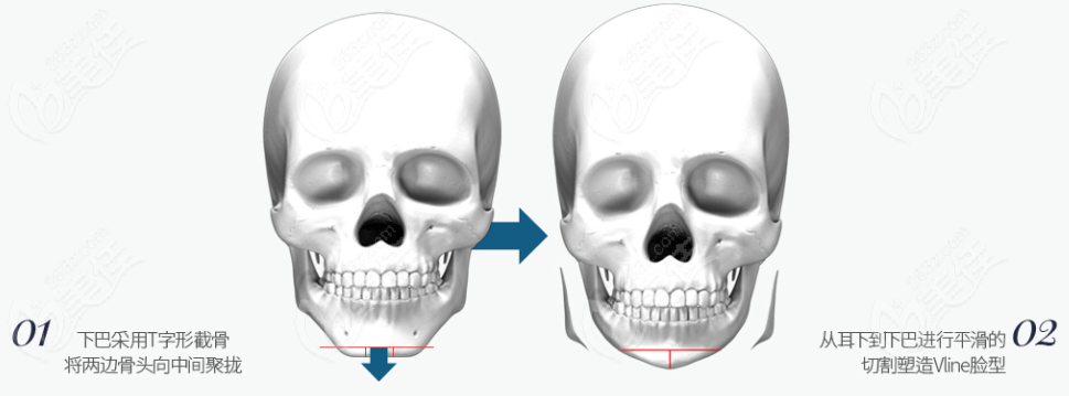 Is OPERA Plastic Surgery's mandibular angle osteotomy technique effective?