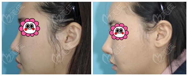 Example of nose repair by Dr. Lee Min-sik at Cosharp Plastic Surgery: