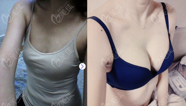 breast implant surgery