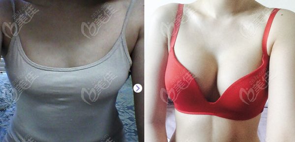 Example of breast revision surgery
