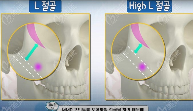 L-shaped high-level osteotomy