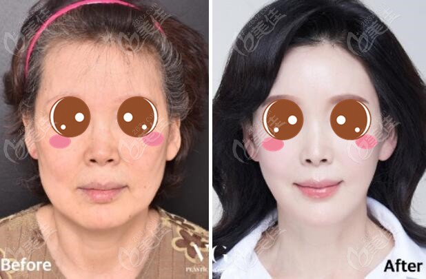 Facelift at VG Plastic Surgery