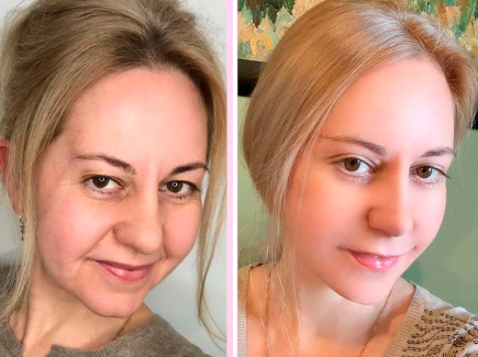 Deep plane facelift before and after in Korea