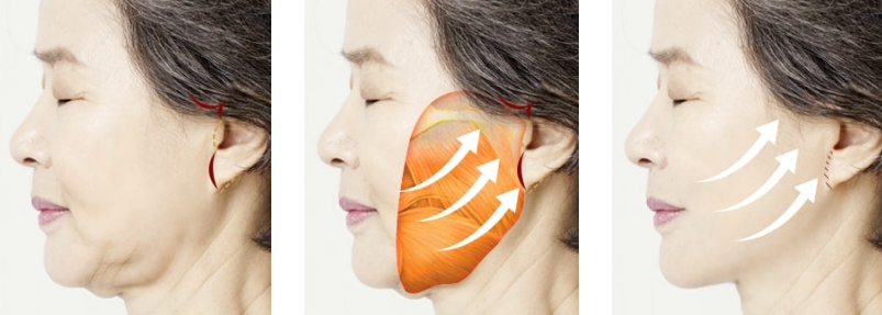 What is a deep plane facelift? Deep plane facelift price Korea