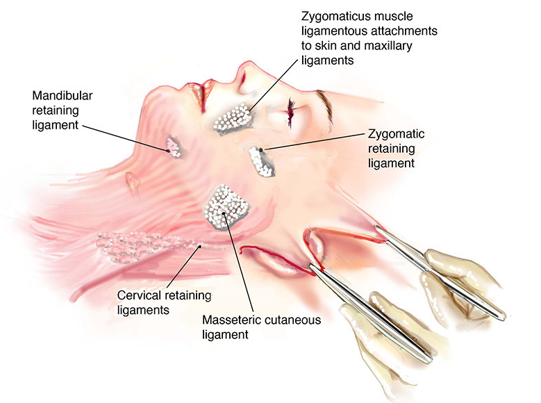 What is a deep plane facelift?